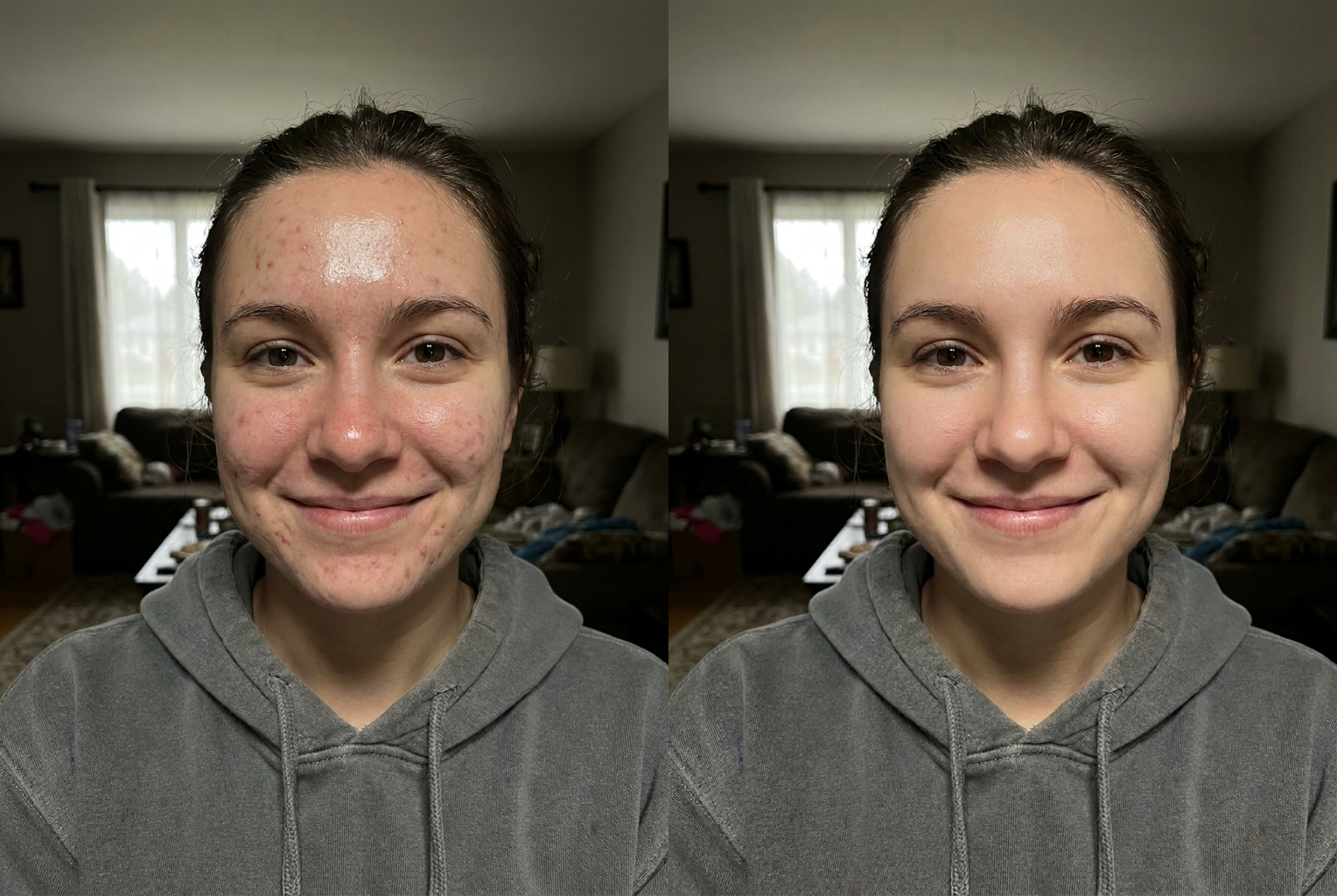 Before → After: blemish removal + skin smoothing
